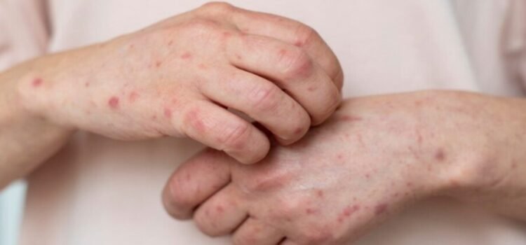 Se confirman 2 casos nuevos de sarampión en el estado de Querétaro