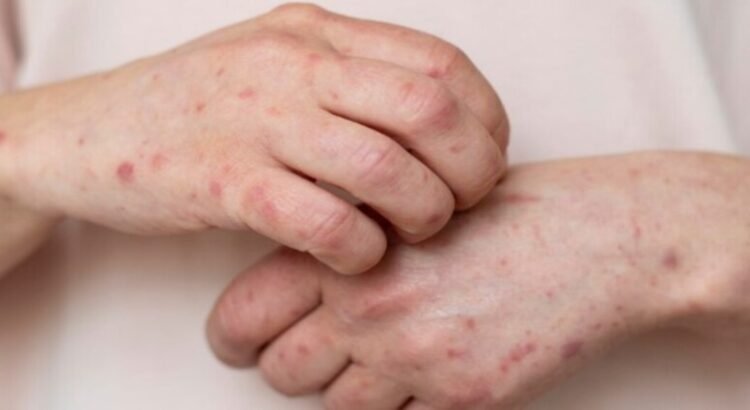 Se confirman 2 casos nuevos de sarampión en el estado de Querétaro Se confirman 2 casos nuevos de sarampión en el estado de Querétaro