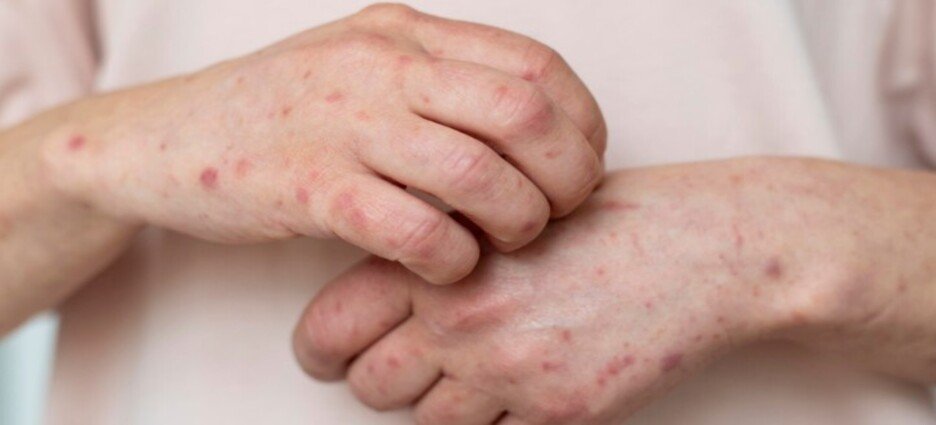 Se confirman 2 casos nuevos de sarampión en el estado de Querétaro